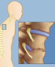 Ankylosing Spondylosis