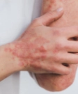 Psoriasis Ayurveda