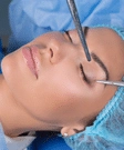 Blepharoplasty