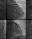 Coronary