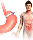 Gastric Band