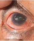 Glaucoma