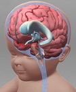 Hydrocephalus