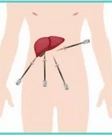 Cholecystectomy