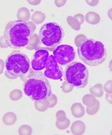 Leukemia