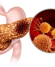 Pancreatic Cancer