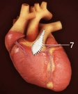 Tetralogy